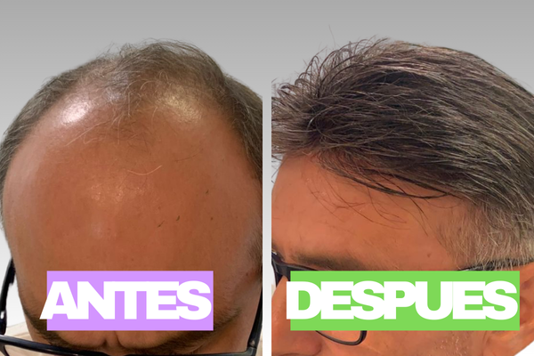 Integración de cabello natural con sistema capilar personalizado