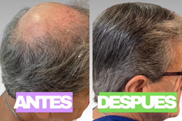 Resultado natural de prótesis capilar en Centro Capilar Belgrano
