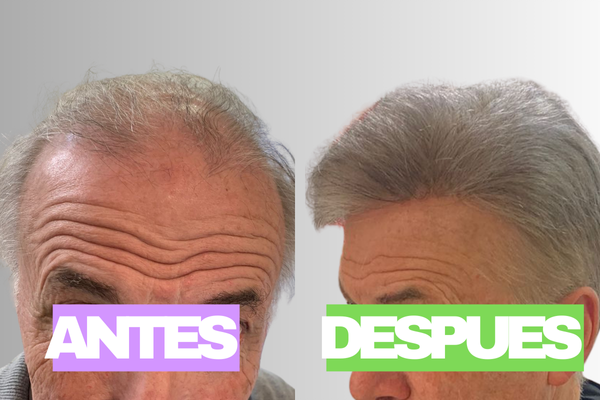 Aplicación de prótesis capilar indetectable en Buenos Aires
