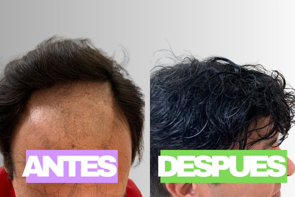 Cliente con sistema capilar premium en Buenos Aires